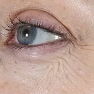 wrinkle relaxers botox eyes 1 before